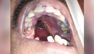 Cancer Screening Before